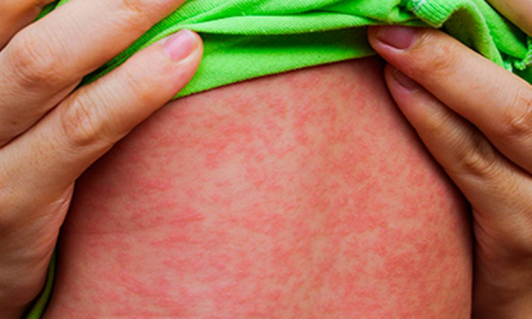 Surtos de sarampo no Brasil aumentam preocupação e impulsionam campanha de vacinação