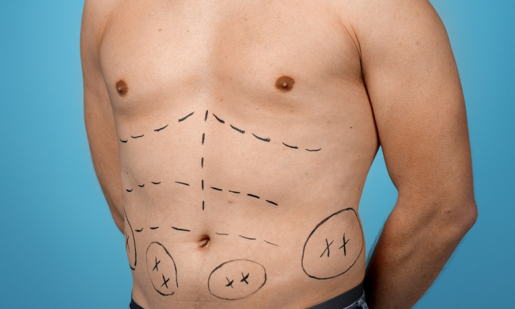 Homens com peitos grandes: entenda as causas e saiba quando a cirurgia é recomendada