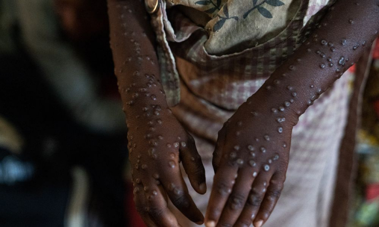 Brasil quase atinge 90 casos confirmados de Mpox