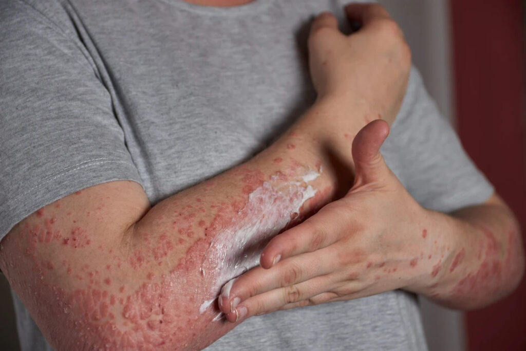 Epidemia de sarampo se espalha nas Américas e Brasil intensifica monitoramento sanitário